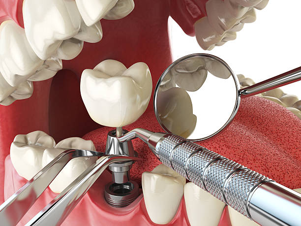 Best Emergency Root Canal Therapy in Pickens, MS